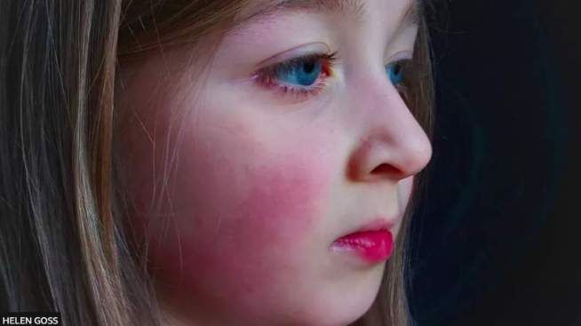 Long COVID in Scotland: NHS Trust Accused of Medical Negligence